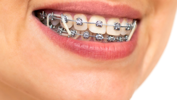 Why You Should Wear Elastics With Your Houston Braces